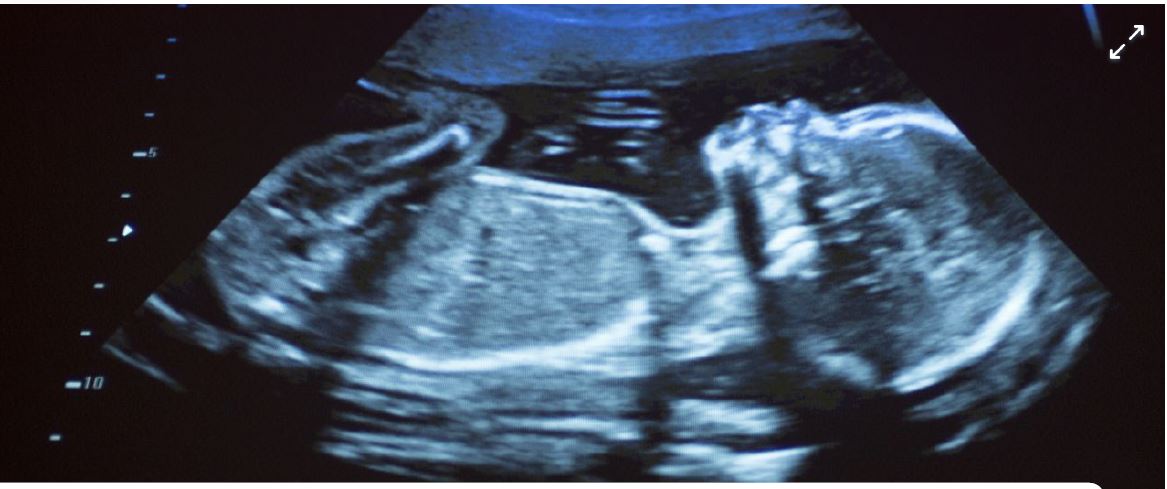 Researchers find soot particles in vital organs of the unborn